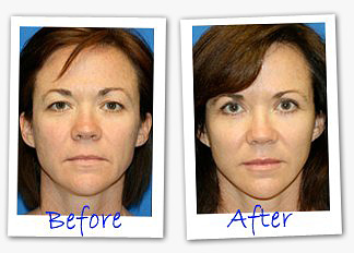 Eye secrets before and after